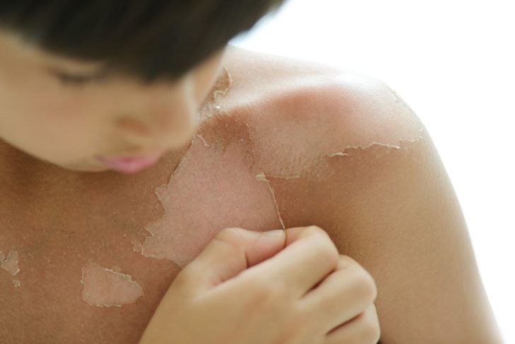 sun burned skin