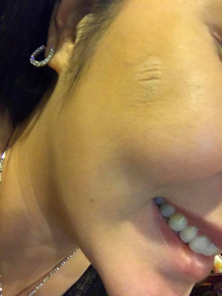 ตั๊ก บงกช หน้าไหม้ (1)