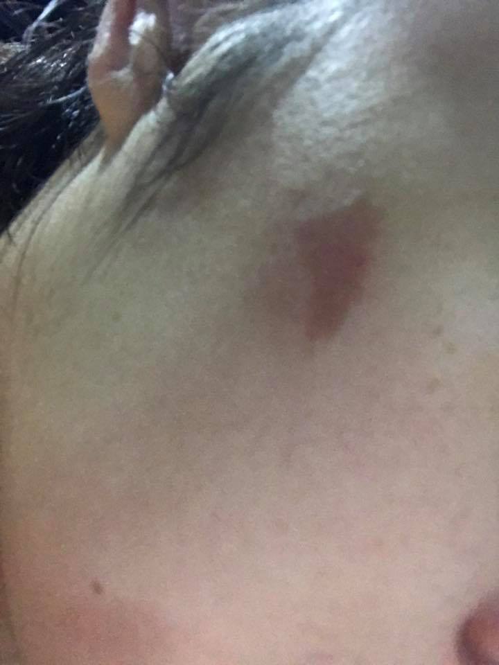 ตั๊ก บงกช หน้าไหม้ (5)