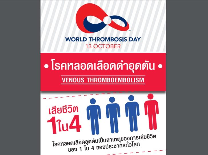 โรคหลอดเลือดดำอุดตัน