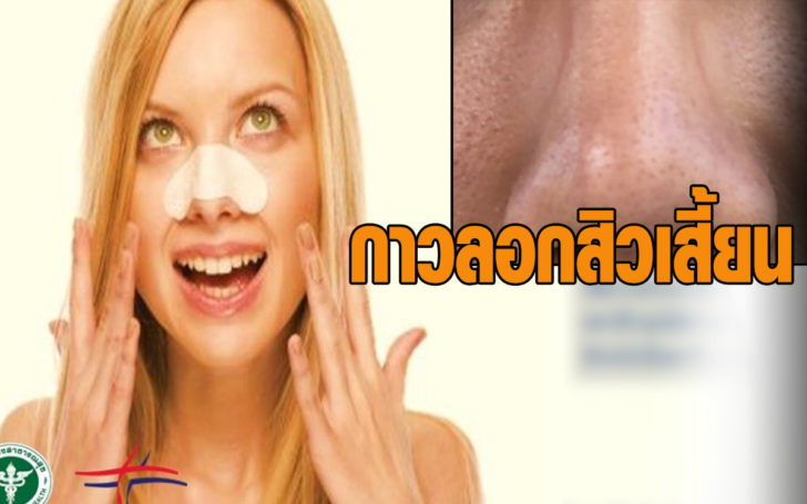 กาวลอกสิวเสี้ยน