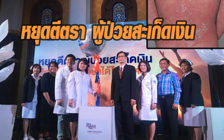 สะเก็ดเงิน