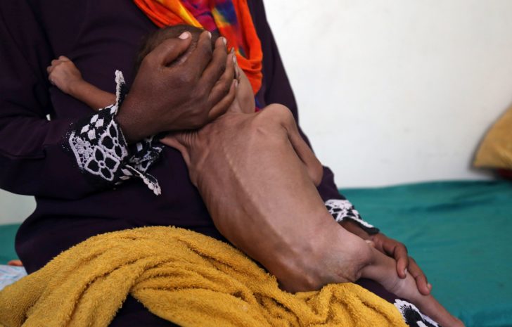 YEMEN-CONFLICT-MALNUTRITION