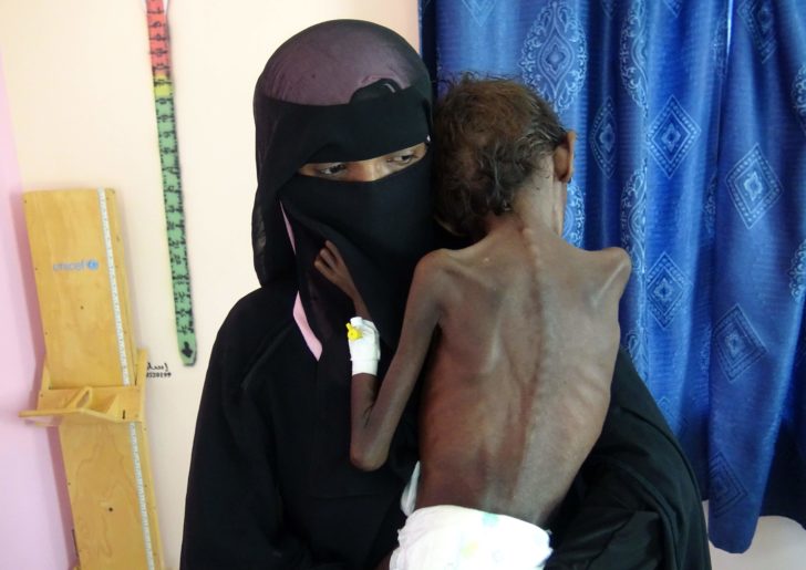 YEMEN-CONFLICT-MALNUTRITION