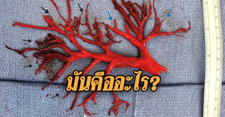 ลิ่มเลือดในปอด