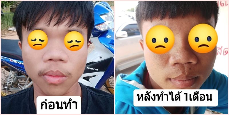สาวโพสต์เตือนพาน้องชาย ทำจมูกคลินิกเมืองอุบลฯ เหมือนไม่ได้ทำ สาวโพสต์เตือนพาน้องชาย ทำจมูกคลินิกเมืองอุบลฯ เหมือนไม่ได้ทำ