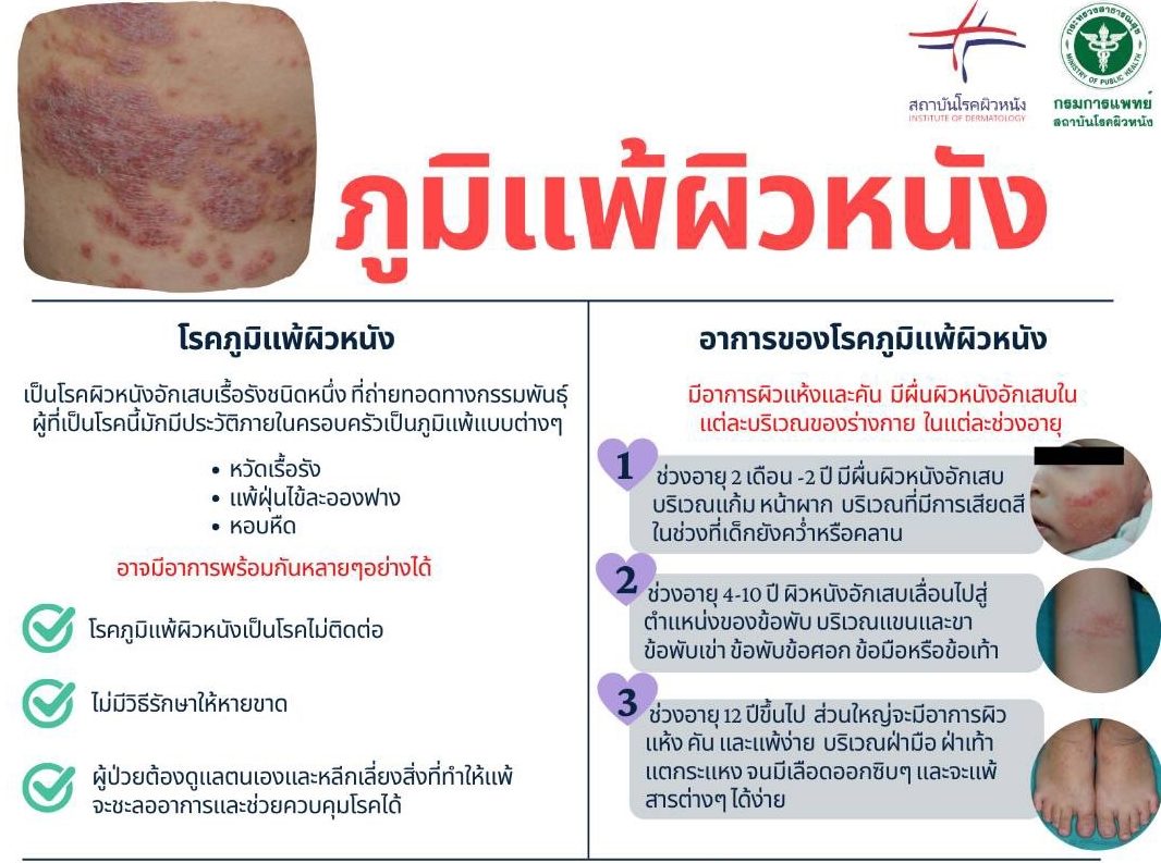 ผื่นภูมิแพ้ผิวหนังอักเสบ ผู้ใหญ่