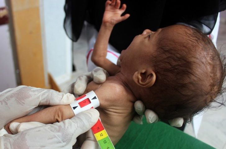 YEMEN-CONFLICT-HEALTH-HUNGER