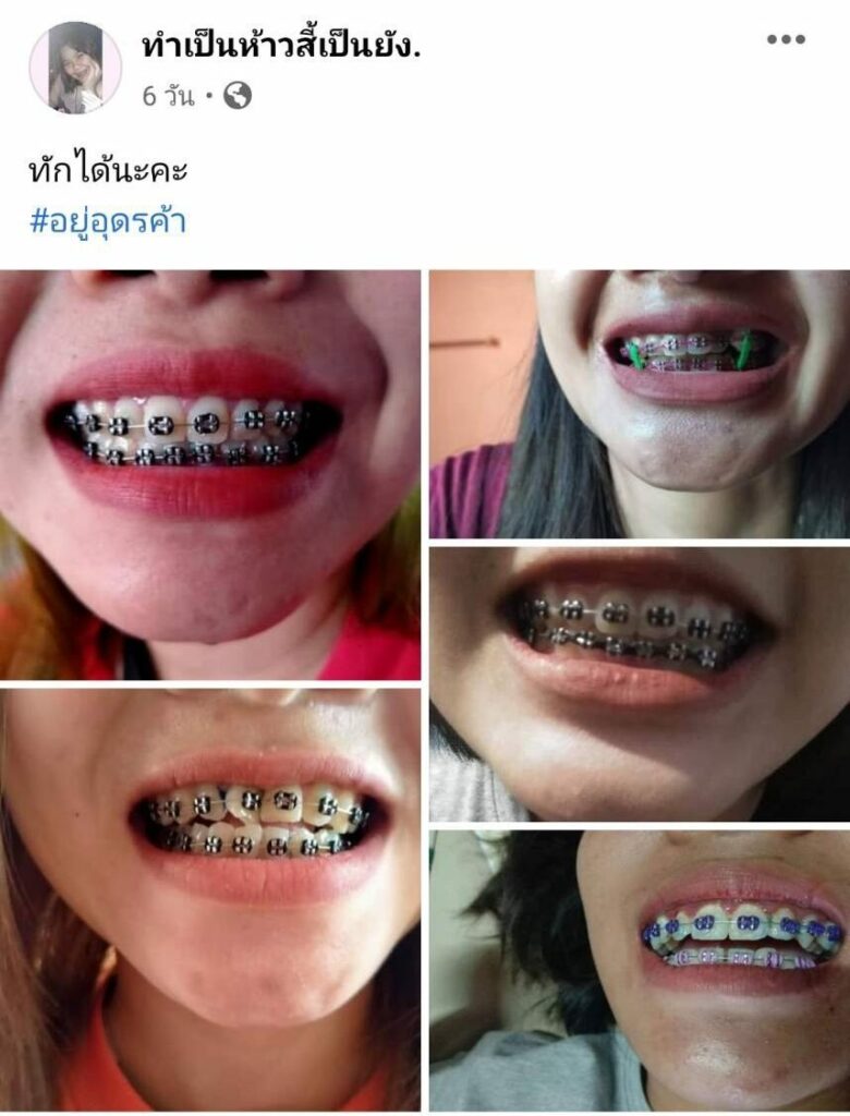 ปคบ. รวบผู้ต้องหา เปิดเพจ 'รับจัดฟันเถื่อน-ขายอุปกรณ์แฟชั่น'  หลักฐานมัดตัวชัด