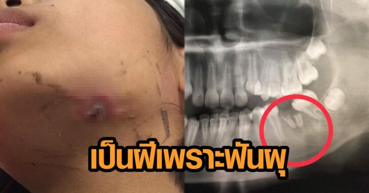 เป็นฝี