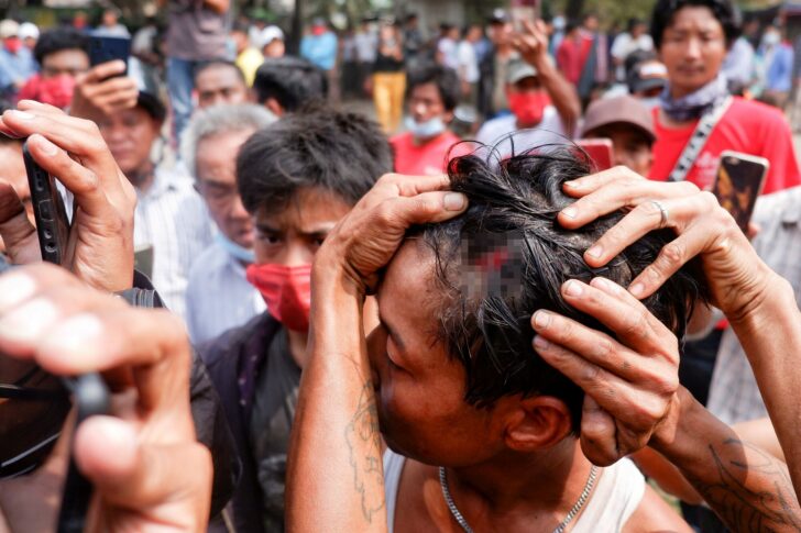 A man shows an injury after the police fired rubber bullets during protests against the military coup, in Mandalay