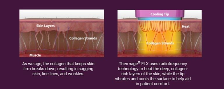 การทำงานของThermage FLX 