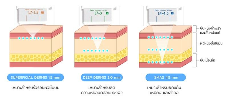 ระดับความลึกในการยิงของ หัว Ulthera
