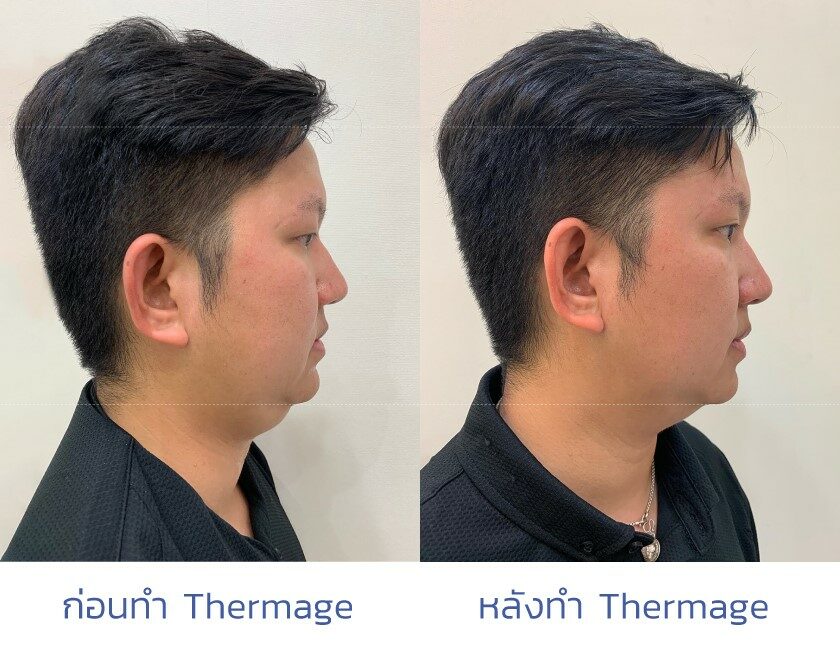 รีวิว ทำ thermage