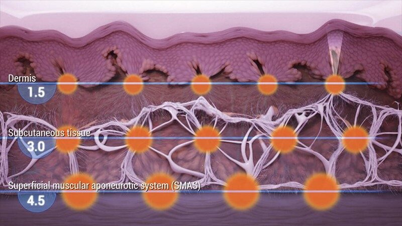 หน้าจอแสดงระดับความลึกในการยิงของ Ulthera