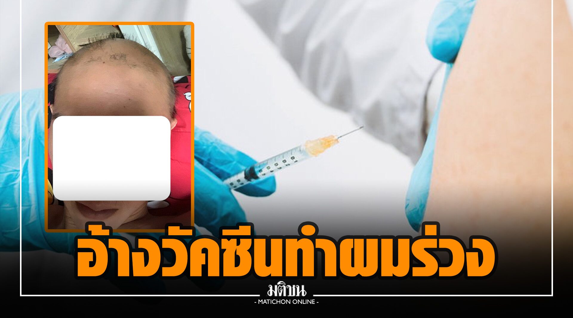 เพจดังโพสต์ ผู้ใช้เฟซบุ๊กอ้างผมร่วงหลังฉีดวัคซีน ถามต้องได้รับชดเชยไหม
