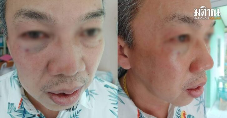 ปกเฟซปลัดโดนต่อย0
