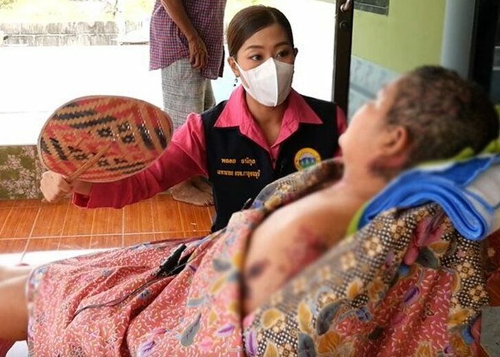 สปสช.เขต 5 ราชบุรี เร่งช่วยเหลือเยียวยาหญิงผิวพุพองหลังฉีดวัคซีนโควิด