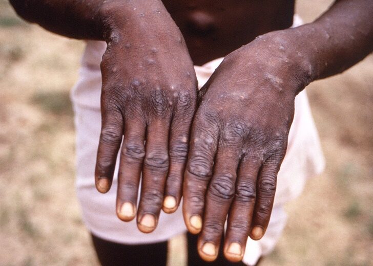 A CDC image shows a rash on a monkeypox patient