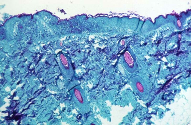 A section of skin tissue, harvested from a lesion on the skin of a monkey, that had been infected with monkeypox virus