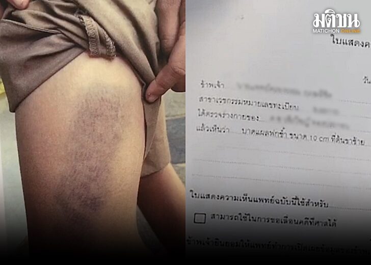 ลูกโดนเตะบอลอัดใส่