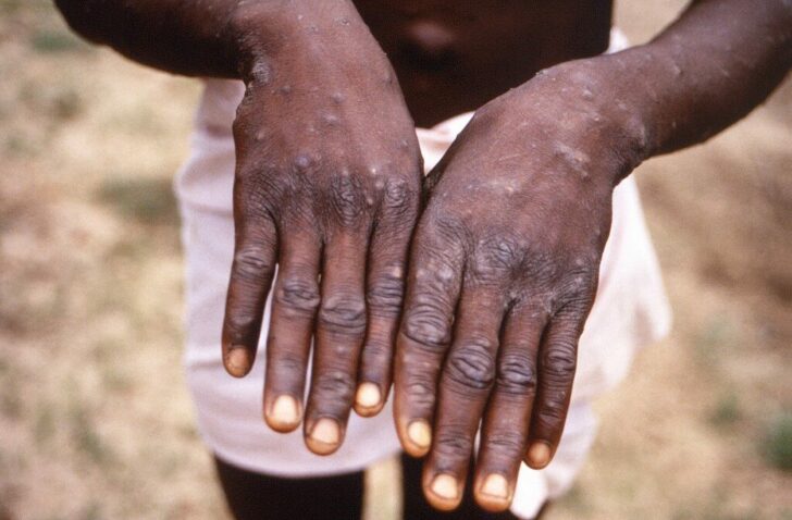 DRC-WHO-HEALTH-VIRUS-MONKEYPOX