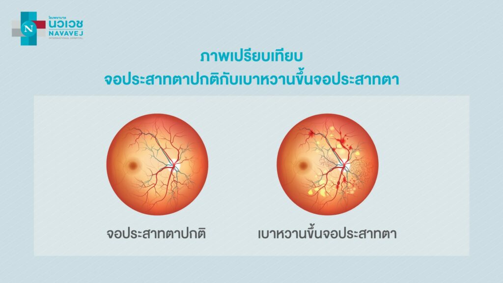 ภาพเปรียบเทียบดวงตา ภาวะปกติกับภาวะเบาหวานขึ้นตา