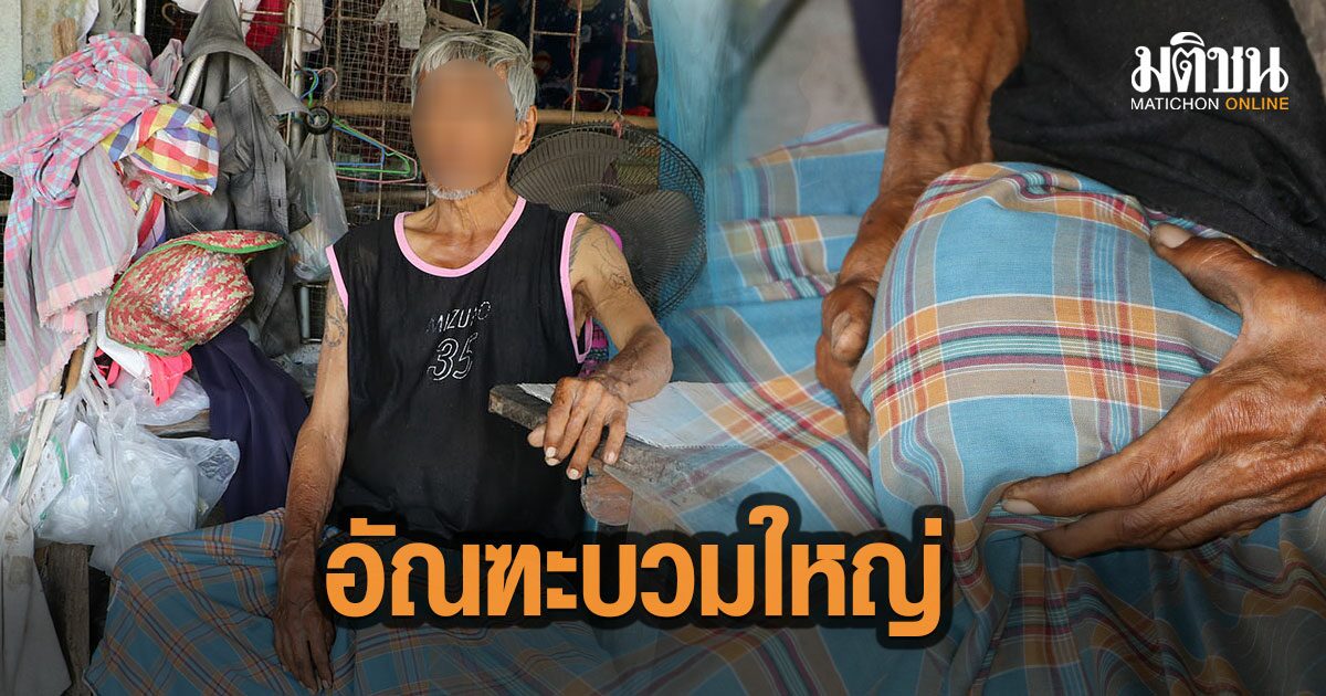 วอนแพทย์ช่วย ลุงวัย 60 ปี สุดทรมานป่วย อัณฑะบวมใหญ่ เท่าลูกมะพร้าว ยากลำบากทำงานไม่ได้
