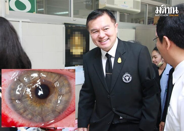 รพ.เพชรบูรณ์ ปลูกถ่ายกระจกตาสำเร็จ ช่วยผู้ป่วยกลับมามองเห็น – ใช้ชีวิตปกติ