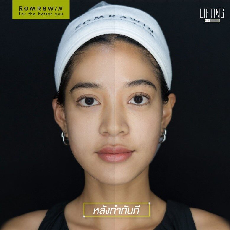 ulthera หน้าบวม ทำอย่างไร ulthera หน้าบวม ทำอย่างไร