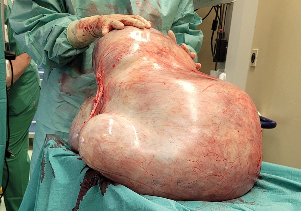 tumour