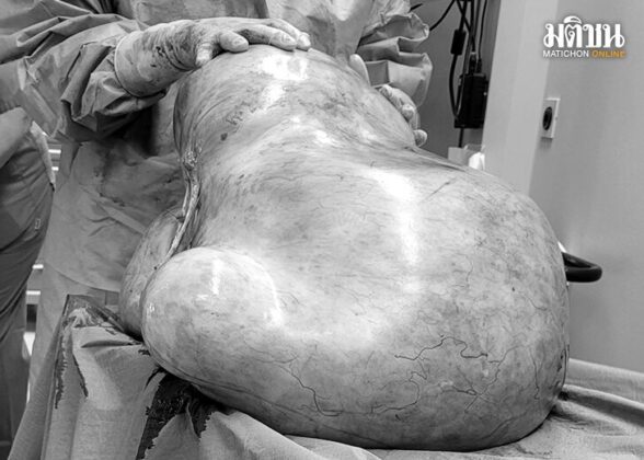 tumour
