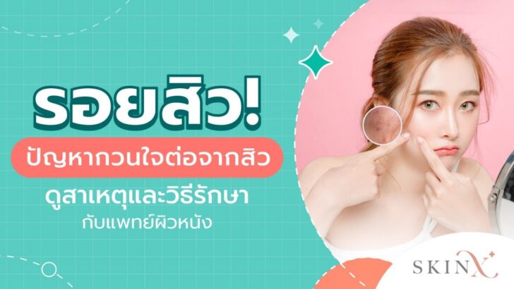 01 รอยสิว