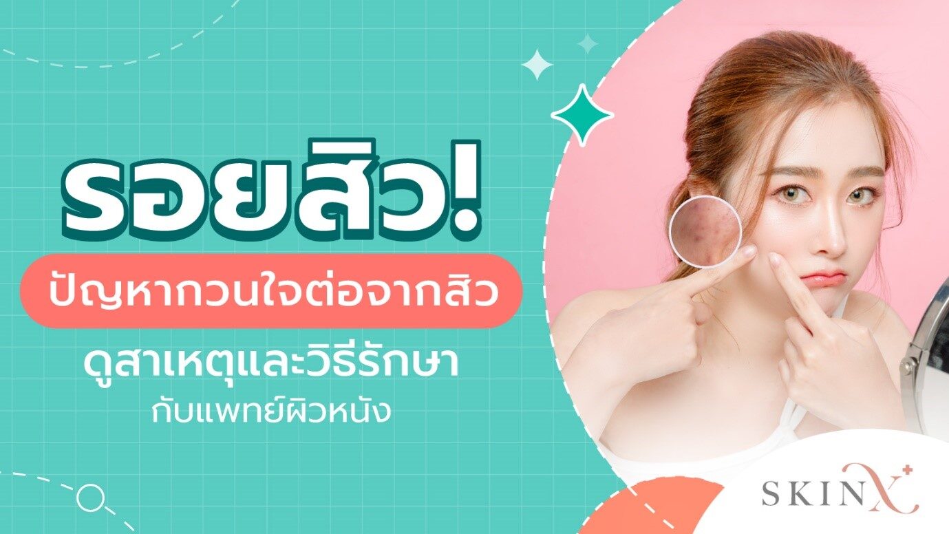 รอยสิว