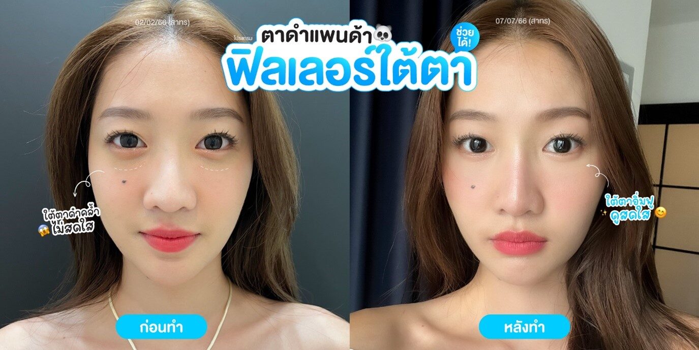 เติมใต้ตา