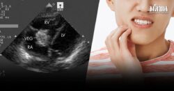 เพจดังยกเคส เด็กญี่ปุ่นวัย 4 ขวบ เป็นไข้ 2 เดือน หาหมอเจอ ก้อนที่เกาะลิ้นหัวใจ อึ้งเหตุจากฟันผุ