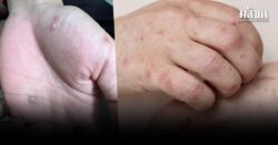 หมอเตือน ซิฟิลิส ระบาดหนัก ในวัยรุ่นเพิ่มขึ้น เด็กอายุ14 เผยอาการ พบแพทย์ด่วน