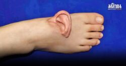 ศัลยกรรมพิสดาร ทำให้เท้ามีหู