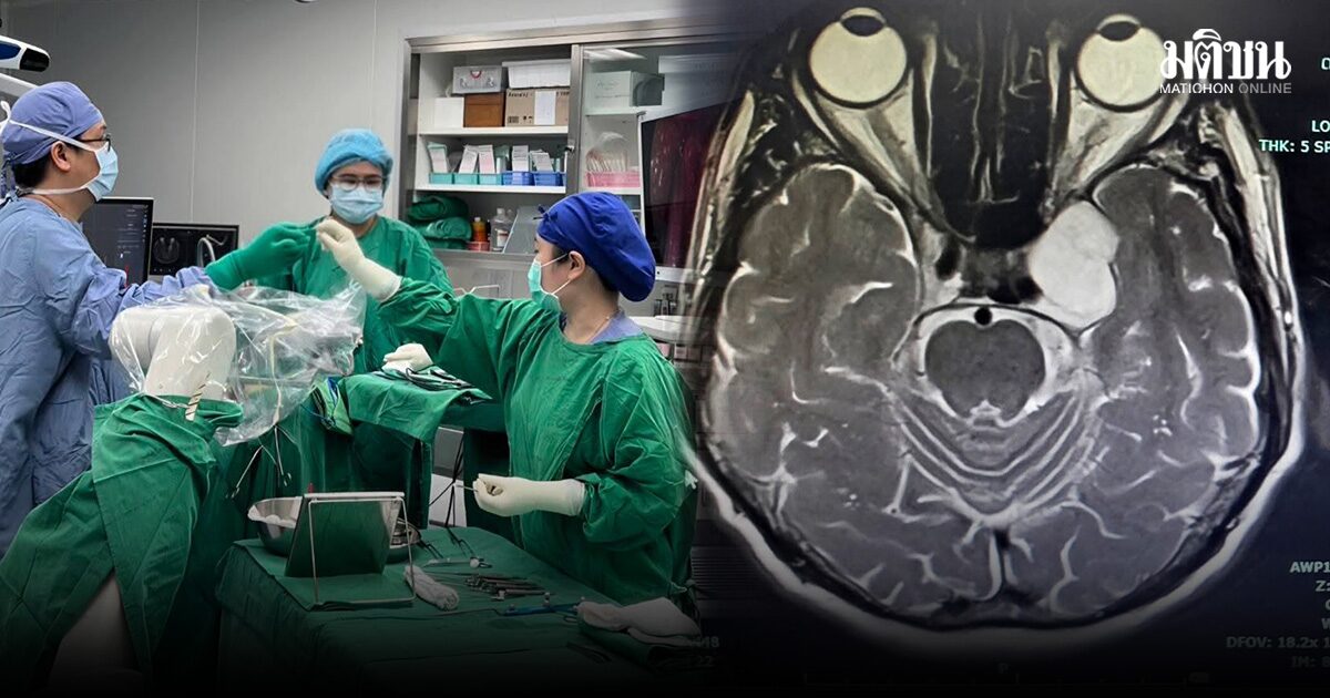 แพทย์รพ.ลำปาง ผ่าตัดสมองผ่านเบ้าตา ไม่ต้องเปิดกะโหลกขนาดใหญ่ 2 วันกลับบ้านได้