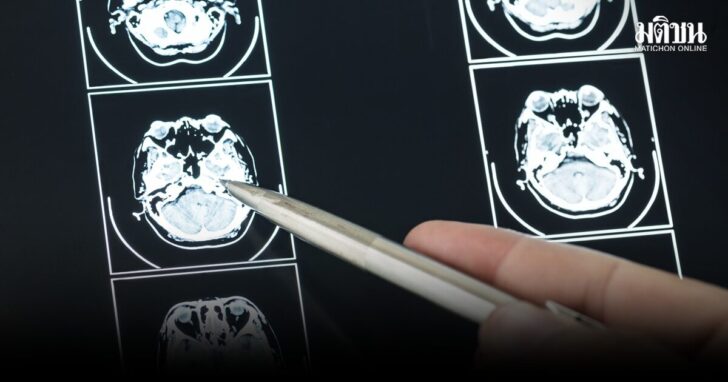 Closeup of brain MRI scan result
