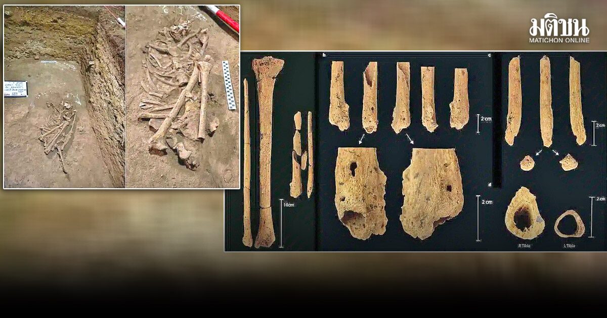 สะพานแห่งกาลเวลา : ศัลยกรรมยุคก่อนประวัติศาสตร์