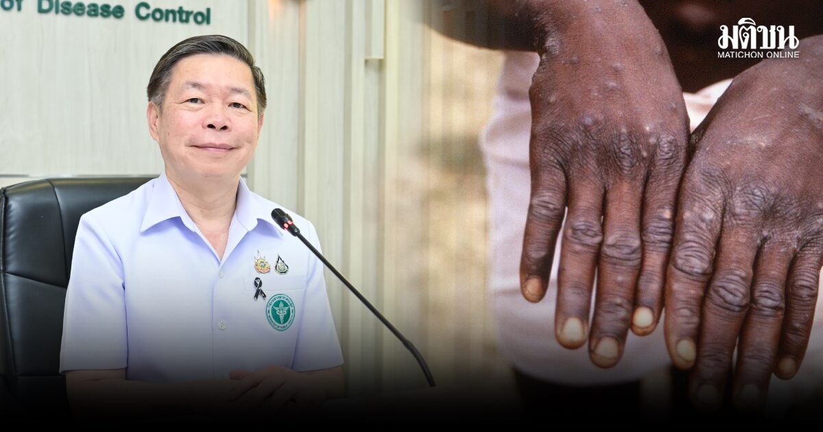 สธ.จับตา’ฝีดาษลิง’ระบาดหลังสงกรานต์ เผยป่วยสะสม 48 ราย ส่วนใหญ่เป็นเพศชาย-วอนปชช.สวมถุงยางป้องกัน