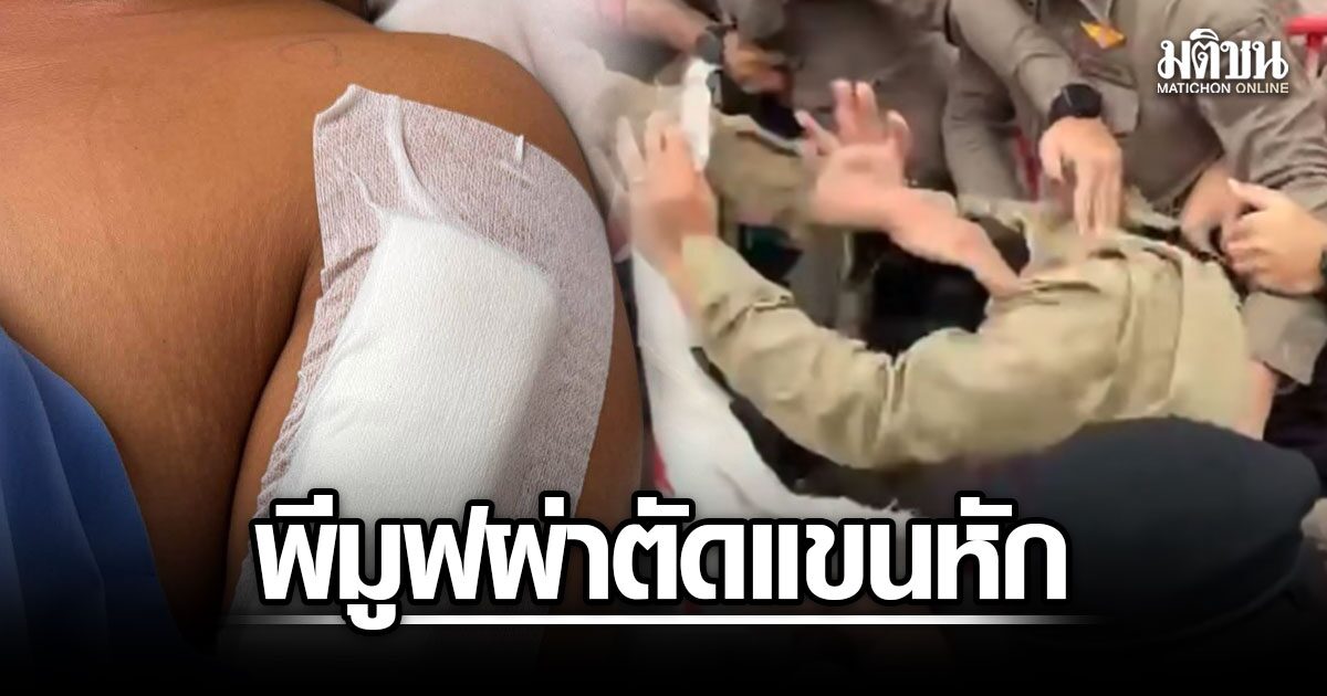 วิศรุต พีมูฟ ผ่าตัดแขนหักสำเร็จ หลังเหตุสลายชุมนุมเชียงใหม่ — นอน รพ. อีก 1 สัปดาห์ แต่ยังสู้ต่อ